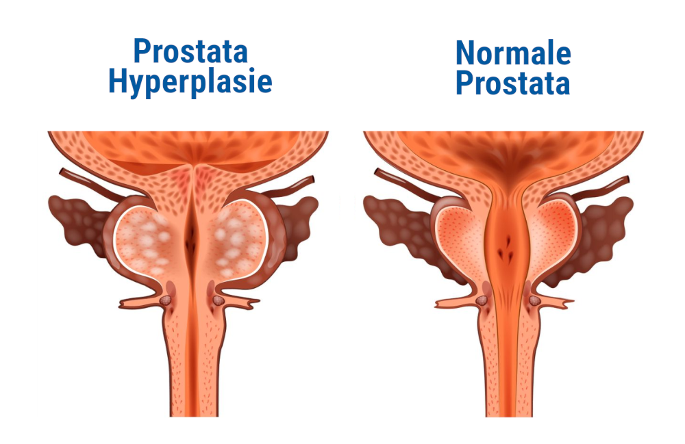 Symptome der benignen Prostatahyperplasie